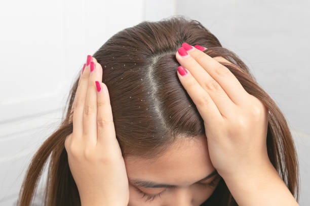 How To Get Rid Of Dandruff 